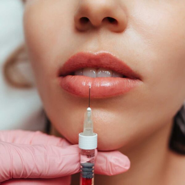 Aumento y Perfilado de Labios